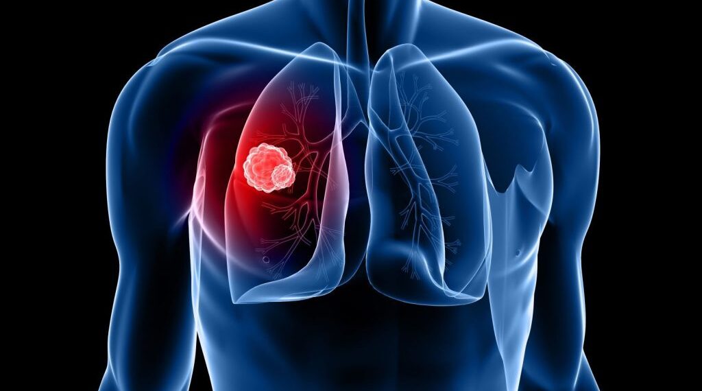 السويد تخفض وفيات سرطان الرئة بنسبة 42% خلال عقد واحد